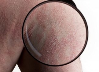Psoriazis, boala autoimună care afectează 2% din populaţia României