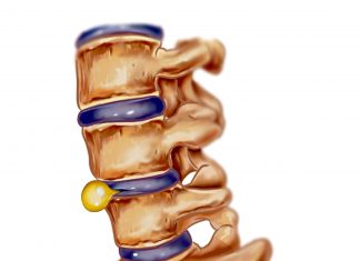Hernia de disc – cauze şi simptome