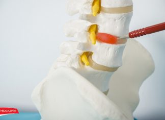 Munca la calculator şi hernia de disc cervical
