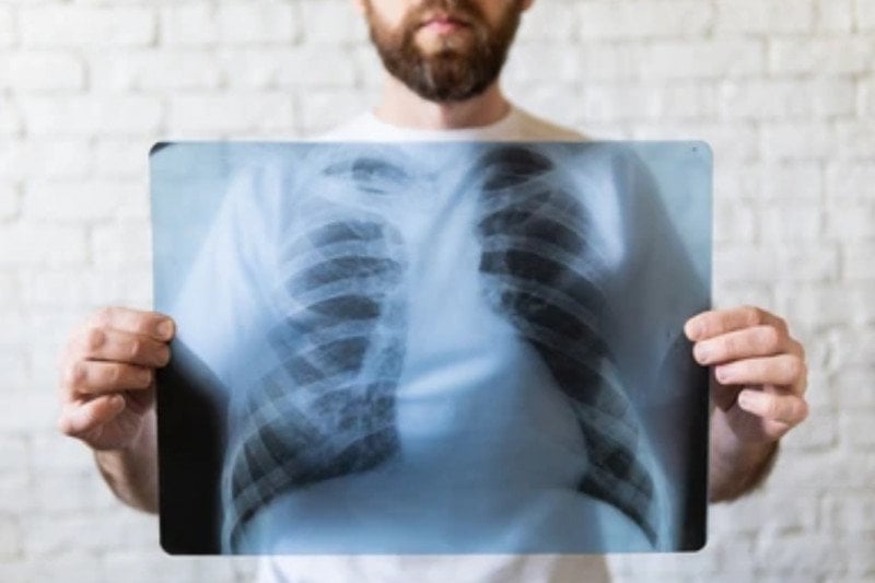 Radiografii pulmonare com Limanu